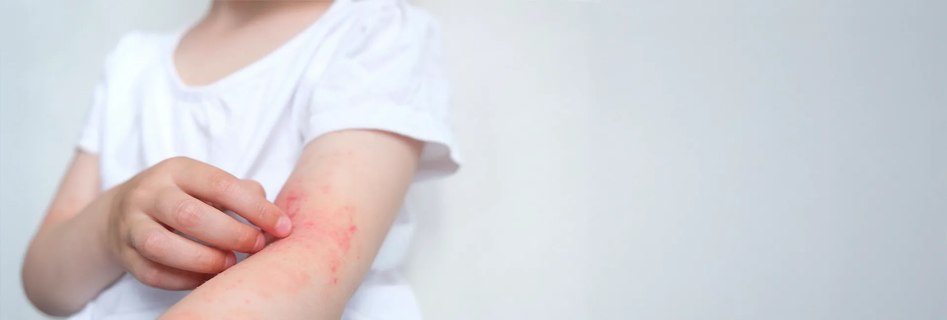 Child scratching a rash on their arm