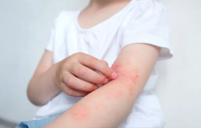 Child scratching a red rash on their arm