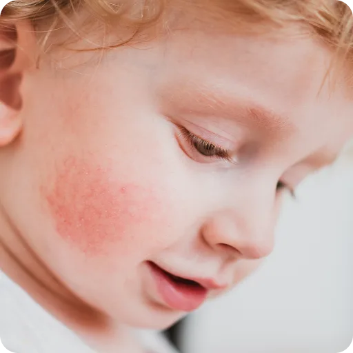 Young child with red patches on the cheek