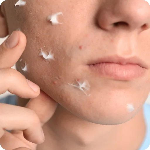 Close-up of acne spots with cream applied