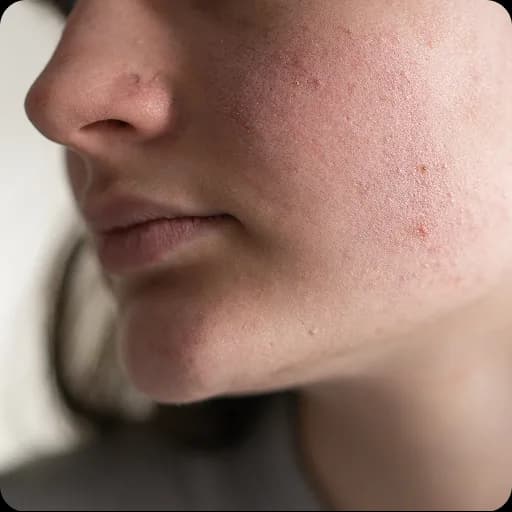 Close-up of skin with acne on the jaw